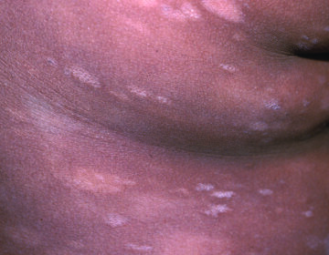 Example of Stage IA/IB MF-CTCL as Hypopigmentation